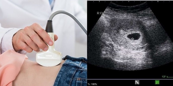 Siêu âm thai là một trong những phương pháp chẩn đoán chính xác tình trạng dây rốn quấn cổ